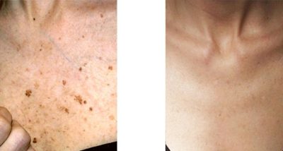 skin-renewal-treatment-progress